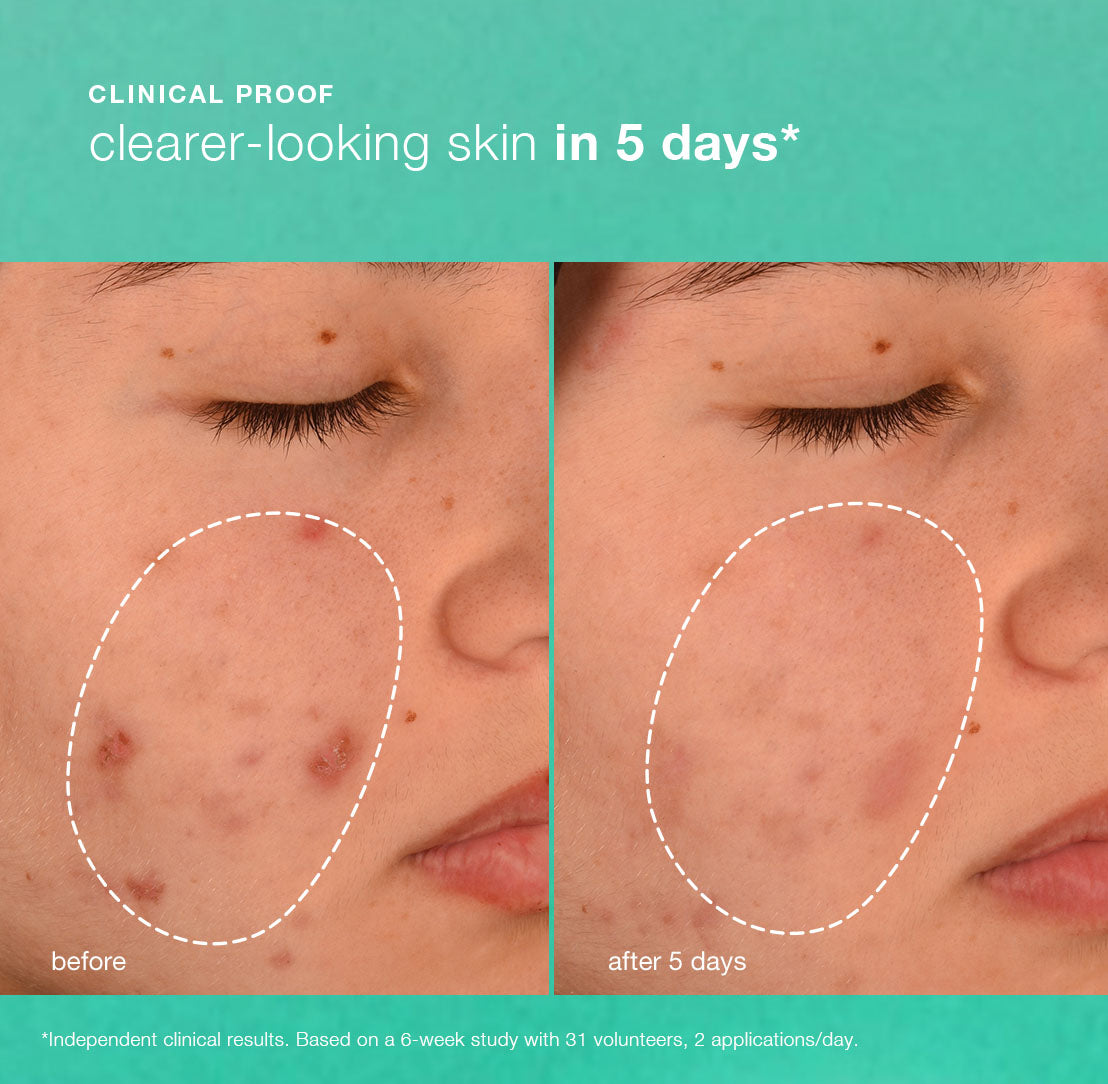 Breakout Biotic Moisturizer